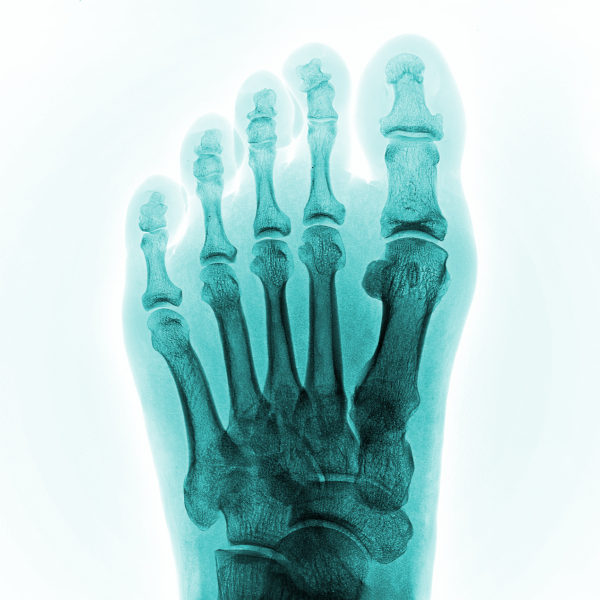 X-Ray film of human feet